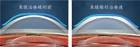 預(yù)防近視,延緩近視加深,近視矯正,角膜塑形鏡 預(yù)防近視,延緩近視加深,近視矯正,角膜塑形鏡