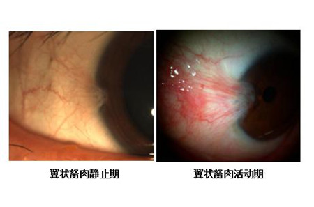 翼狀胬肉,翼狀胬肉成因,翼狀胬肉治療 翼狀胬肉,翼狀胬肉成因,翼狀胬肉治療