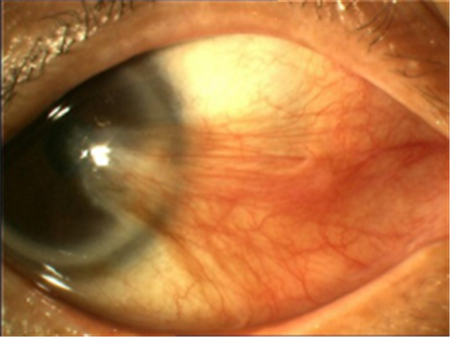 紫外線,電光性眼炎,翼狀胬肉,胬肉切除 紫外線,電光性眼炎,翼狀胬肉,胬肉切除