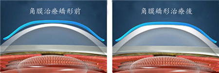 ok鏡的矯視原理