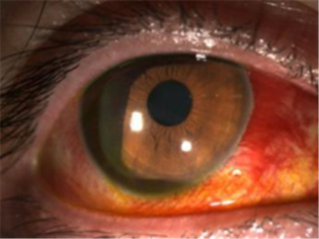 眼表出血嚴(yán)不嚴(yán)重