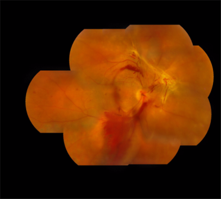 糖網(wǎng)病,視網(wǎng)膜病變,黃斑水腫治療,視網(wǎng)膜脫落治 糖網(wǎng)病,視網(wǎng)膜病變,黃斑水腫治療,視網(wǎng)膜脫落治