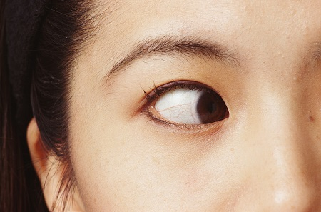 小兒斜視,兒童斜視,斜視治療,斜視矯正 小兒斜視,兒童斜視,斜視治療,斜視矯正