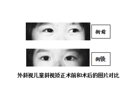 小兒斜視,兒童斜視,斜視治療,斜視矯正 小兒斜視,兒童斜視,斜視治療,斜視矯正