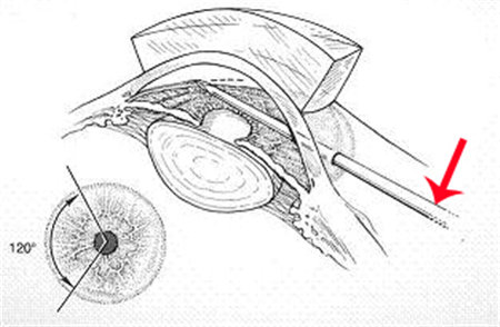 青光眼,小兒青光眼,先天性青光眼,兒童青光眼治 青光眼,小兒青光眼,先天性青光眼,兒童青光眼治