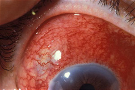 廣泛性前鞏膜炎