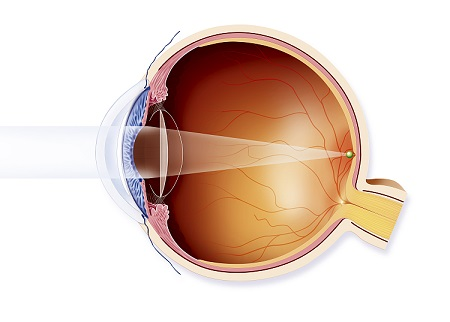 白內(nèi)障,小兒白內(nèi)障,兒童白內(nèi)障,白內(nèi)障治療 白內(nèi)障,小兒白內(nèi)障,兒童白內(nèi)障,白內(nèi)障治療
