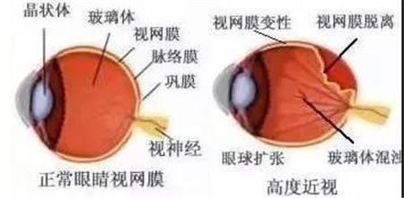 視網膜脫落,視網膜脫落癥狀,視網膜脫落治療 視網膜脫落,視網膜脫落癥狀,視網膜脫落治療