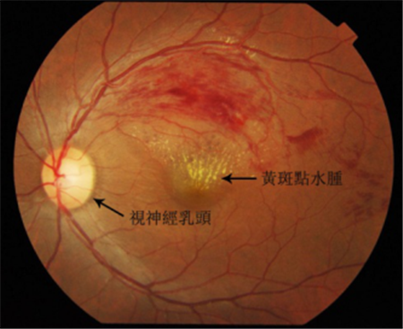 視網膜靜脈阻塞