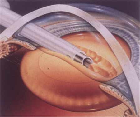 白內障,青光眼,白內障手術,青光眼治療 白內障,青光眼,白內障手術,青光眼治療