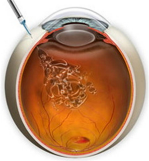 黃斑病變,黃斑變性,黃斑變性癥狀,黃斑變性治療 黃斑病變,黃斑變性,黃斑變性癥狀,黃斑變性治療