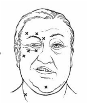 眼瞼痙攣,肉毒桿菌注射,眼皮跳 眼瞼痙攣,肉毒桿菌注射,眼皮跳