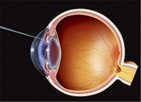 白內障手術,白內障怎么辦,白內障什么時候手術 白內障手術,白內障怎么辦,白內障什么時候手術