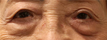 眼袋怎么去,眼袋成因,眼袋去除手術(shù) 眼袋怎么去,眼袋成因,眼袋去除手術(shù)