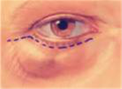 眼袋怎么去,眼袋成因,眼袋去除手術(shù) 眼袋怎么去,眼袋成因,眼袋去除手術(shù)