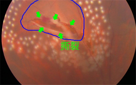 眼前有黑影,飛蚊癥怎么辦,飛蚊癥治療,飛蚊癥會 眼前有黑影,飛蚊癥怎么辦,飛蚊癥治療,飛蚊癥會