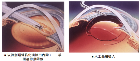 白內(nèi)障怎么辦,白內(nèi)障治療,白內(nèi)障手術(shù),白內(nèi)障手 白內(nèi)障怎么辦,白內(nèi)障治療,白內(nèi)障手術(shù),白內(nèi)障手