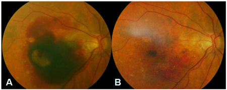 黃斑變性,吸煙傷眼,黃斑變性治療 黃斑變性,吸煙傷眼,黃斑變性治療