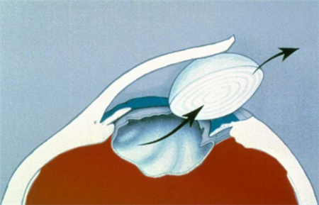 白內障怎么辦,白內障治療,白內障手術,白內障癥 白內障怎么辦,白內障治療,白內障手術,白內障癥