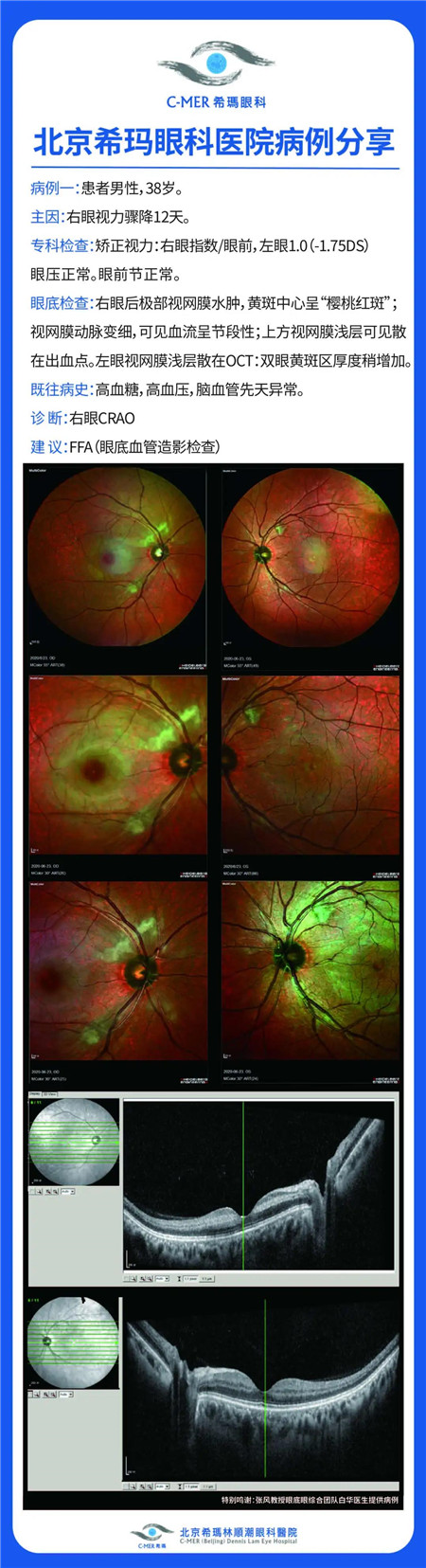 眼中風(fēng),眼中風(fēng)癥狀,眼睛中風(fēng)怎么辦,眼中風(fēng)治療 眼中風(fēng),眼中風(fēng)癥狀,眼睛中風(fēng)怎么辦,眼中風(fēng)治療