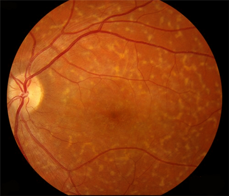 黃斑營養不良,眼底黃色斑點癥,斯特格氏病,卵黃 黃斑營養不良,眼底黃色斑點癥,斯特格氏病,卵黃