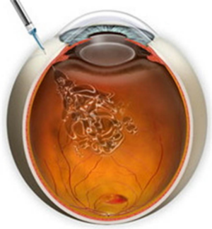 黃斑營養不良,眼底黃色斑點癥,斯特格氏病,卵黃 黃斑營養不良,眼底黃色斑點癥,斯特格氏病,卵黃