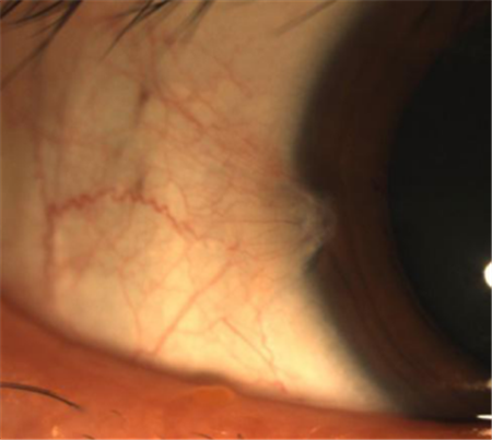 胬肉,翼狀胬肉,眼睛防曬,翼狀胬肉手術 胬肉,翼狀胬肉,眼睛防曬,翼狀胬肉手術