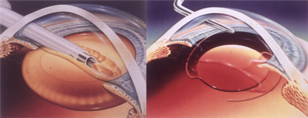 白內(nèi)障,白內(nèi)障手術(shù),白內(nèi)障治療,白內(nèi)障過(guò)熟 白內(nèi)障,白內(nèi)障手術(shù),白內(nèi)障治療,白內(nèi)障過(guò)熟