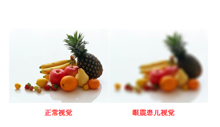 眼球震顫,兒童眼球震顫,先天性眼球震顫,眼球震 眼球震顫,兒童眼球震顫,先天性眼球震顫,眼球震