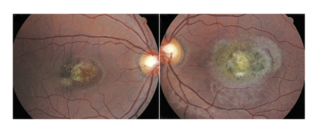 眼球震顫,兒童眼球震顫,先天性眼球震顫,眼球震 眼球震顫,兒童眼球震顫,先天性眼球震顫,眼球震