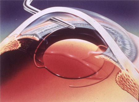 白內(nèi)障,白內(nèi)障治療,白內(nèi)障手術(shù),超聲乳化手術(shù) 白內(nèi)障,白內(nèi)障治療,白內(nèi)障手術(shù),超聲乳化手術(shù)