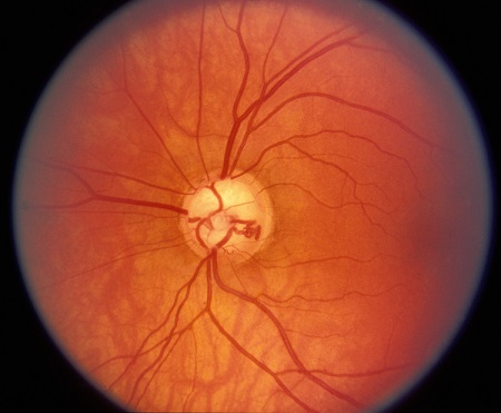 青光眼,為什么得青光眼,青光眼癥狀,青光眼治療 青光眼,為什么得青光眼,青光眼癥狀,青光眼治療