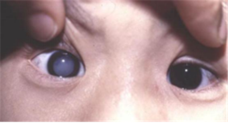 小兒白內障,兒童白內障,白內障治療,白內障手術 小兒白內障,兒童白內障,白內障治療,白內障手術