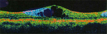 黃斑病變,黃斑水腫,黃斑變性,黃斑裂孔,黃斑前膜 黃斑病變,黃斑水腫,黃斑變性,黃斑裂孔,黃斑前膜