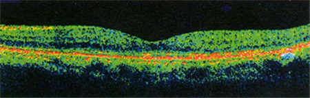 黃斑病變,黃斑水腫,黃斑變性,黃斑裂孔,黃斑前膜 黃斑病變,黃斑水腫,黃斑變性,黃斑裂孔,黃斑前膜