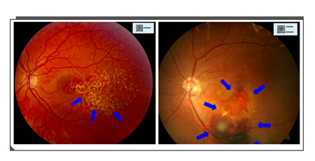 黃斑病變,黃斑水腫,黃斑變性,黃斑裂孔,黃斑前膜 黃斑病變,黃斑水腫,黃斑變性,黃斑裂孔,黃斑前膜
