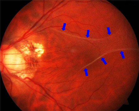 黃斑病變,黃斑水腫,黃斑變性,黃斑裂孔,黃斑前膜 黃斑病變,黃斑水腫,黃斑變性,黃斑裂孔,黃斑前膜