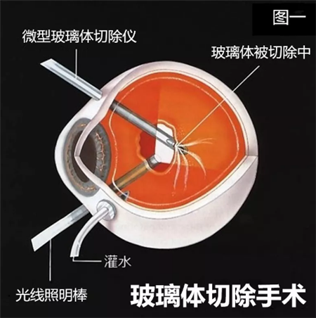 黃斑病變,黃斑水腫,黃斑變性,黃斑裂孔,黃斑前膜 黃斑病變,黃斑水腫,黃斑變性,黃斑裂孔,黃斑前膜