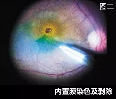 黃斑病變,黃斑水腫,黃斑變性,黃斑裂孔,黃斑前膜 黃斑病變,黃斑水腫,黃斑變性,黃斑裂孔,黃斑前膜