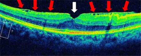 黃斑前膜,黃斑前膜手術,黃斑前膜治療 黃斑前膜,黃斑前膜手術,黃斑前膜治療