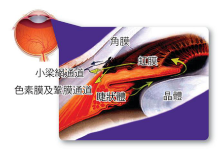 眼脹頭痛,青光眼,青光眼癥狀,青光眼治療 眼脹頭痛,青光眼,青光眼癥狀,青光眼治療