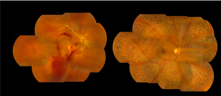 糖尿病,糖網(wǎng)病,視網(wǎng)膜病變,糖網(wǎng)病治療 糖尿病,糖網(wǎng)病,視網(wǎng)膜病變,糖網(wǎng)病治療