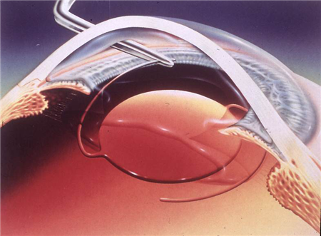 白內(nèi)障,白內(nèi)障癥狀,白內(nèi)障并發(fā)癥,白內(nèi)障手術(shù),晶 白內(nèi)障,白內(nèi)障癥狀,白內(nèi)障并發(fā)癥,白內(nèi)障手術(shù),晶