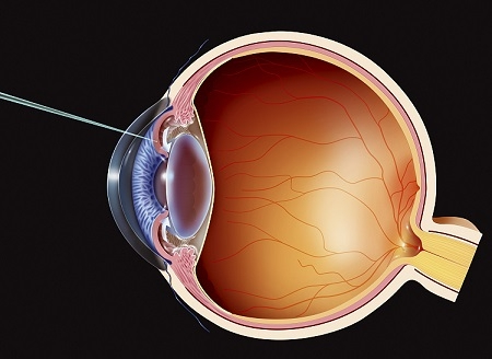 青光眼,青光眼注意事項,青光眼能運動嗎,青光眼 青光眼,青光眼注意事項,青光眼能運動嗎,青光眼