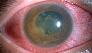 玻璃體出血是怎么回事？北京眼科醫(yī)院