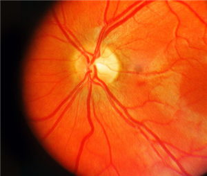 黃斑,黃斑病變,眼底病,黃斑病治療 黃斑,黃斑病變,眼底病,黃斑病治療