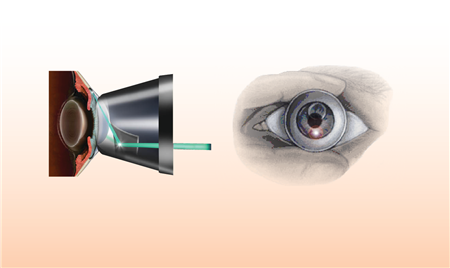 激光虹膜邊緣成形手術