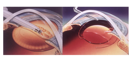 白內(nèi)障,白內(nèi)障癥狀,白內(nèi)障手術(shù),白內(nèi)障治療 白內(nèi)障,白內(nèi)障癥狀,白內(nèi)障手術(shù),白內(nèi)障治療