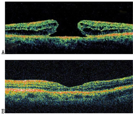 黃斑,黃斑裂孔,黃斑裂孔手術,玻璃體切割手術 黃斑,黃斑裂孔,黃斑裂孔手術,玻璃體切割手術