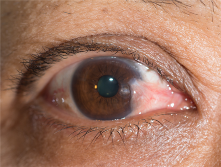 翼狀胬肉的危害